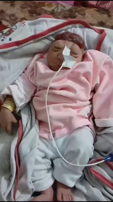 طفلة تولد بلا دماغ