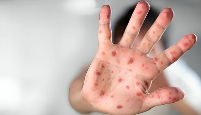 الحصبة تضرب ولاية بنسلفانيا الأمريكية&nbsp;