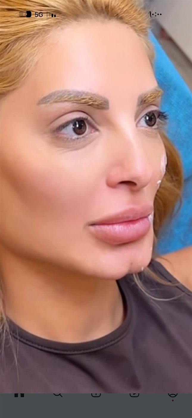 مي حلمي بعد عملية التجميل