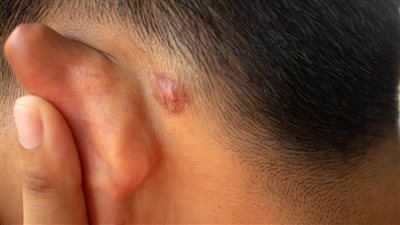 هل تعاني من حب الشباب خلف الأذن؟ .. إليك أسبابه وطرق التعامل معه
