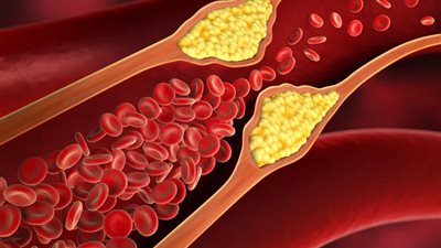 دراسة جديدة تكشف: انخفاض الكوليسترول بالدم يقلل نسبة انتشار سرطان المثانة