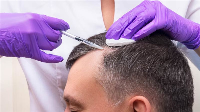 زراعة الشعر