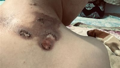 حوادث الألعاب النارية.. لهو يتحول إلى مأساة