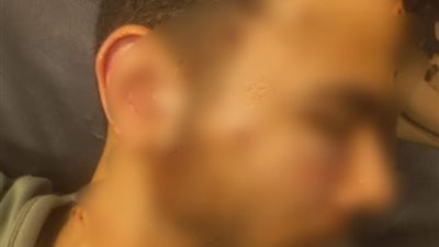 ضحية الرصاصة الطائشة بشبرا الخيمة لـ«تفصيلة»: فقدت بصري للأبد بسبب بلطجية المنطقة