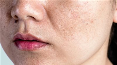 كيف تساعد قشور البطاطس في تقليل التصبغات؟.. إليكِ طريقة مضمونة