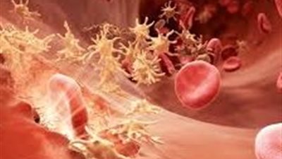 مصر رائدة عالميًا في علاجه .. ما هو مرض الهيموفيليا ؟