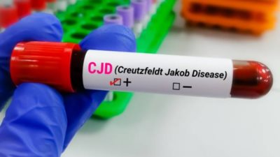 يسبب فقدان ذاكرة.. سر ظهور مرض دماغي غامض في مقاطعة أمريكية