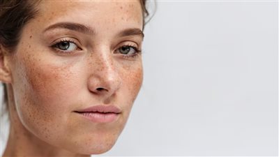هل النمش علامة جمالية أم مشاكل صحية أعمق في الجلد؟