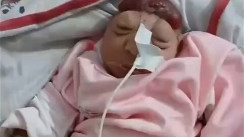 طفلة تولد بلا دماغ