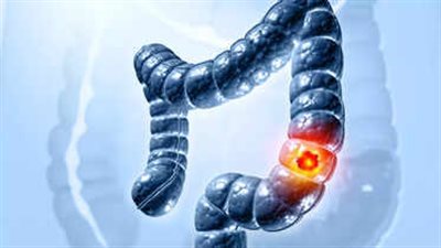 احذر تجاهلها.. 5 أعراض تنذر بسرطان القولون