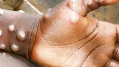 منظمة الصحة العالمية تجدد التحذير من تفشي جدري القرود