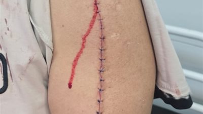 موظف ينجو من الموت بعد اعتداء من بلطجي بمطواة في حلوان