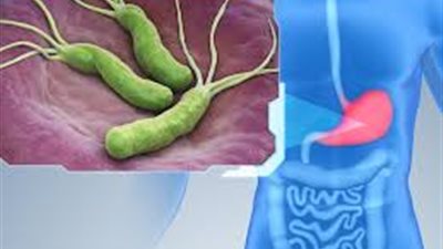 أعراض جرثومة المعدة.. انتشار واسع وتحذيرات من 