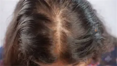 تساقط الشعر ليس عرضًا عابرًا.. إنذار مبكر لأمراض خطيرة