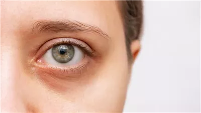 6 أسباب وراء الهالات السوداء تحت العينين.. و8 نصائح فعالة للتخلص منها