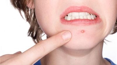 تحذيرات من انتقال الهربس للأطفال.. 5 خطوات للوقاية من العدوى