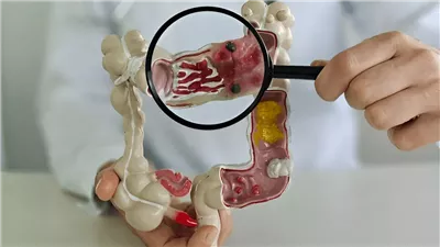 أطعمة يجب تجنبها لتجنب الإصابة بسرطان القولون 