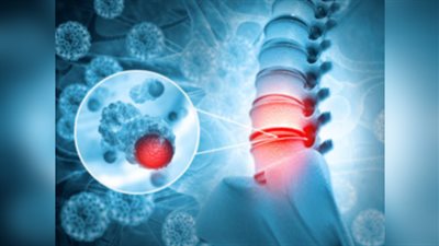 6 أطعمة تضعف العظام.. انتبه لما تأكله يوميًا