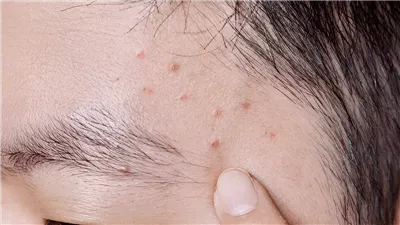 علاجات منزلية للتغلب على حب الشباب 