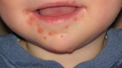 طبيب مناعة: 