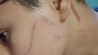 قطعوا وشه بقلم جاف .. سيدة تستغيث بعد الاعتداء على نجلها أمام مدرسة بالإسكندرية (صور)