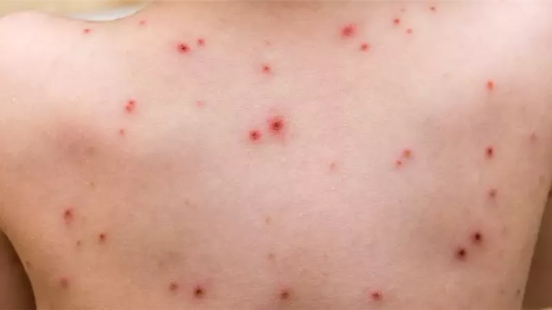 جدري القرود