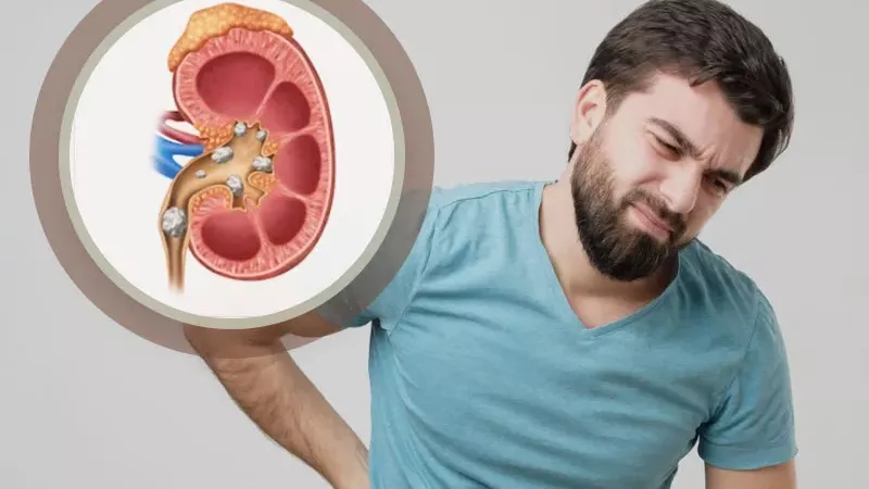 حصوات الكلى