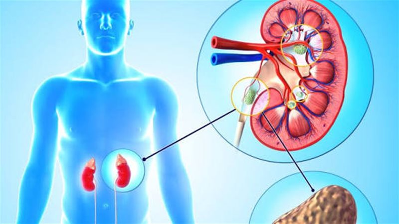 حصوات الكلى 