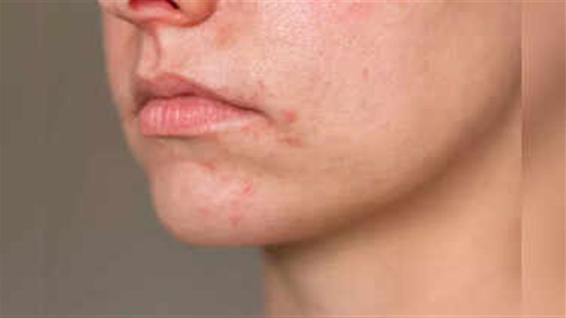 التهاب الجلد حول