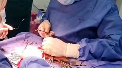 نجاح جراحة دقيقة لإصلاح أوتار يد مريض بمستشفى العدوة المركزي