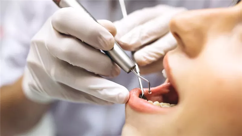 تنظيف الأسنان 