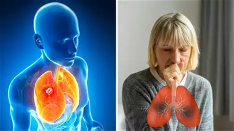 سرطان الرئة 