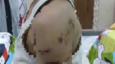 هجوم كلب يُصيب طفلًا بدمنهور ويثير حالة من الغضب بين الأهالي