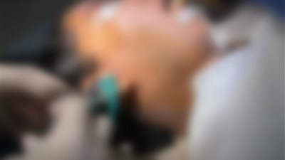 إنهاء معاناة مريضة من آلام الفك.. نجاح تدخل جراحي دقيق بمستشفى صدر المنيا